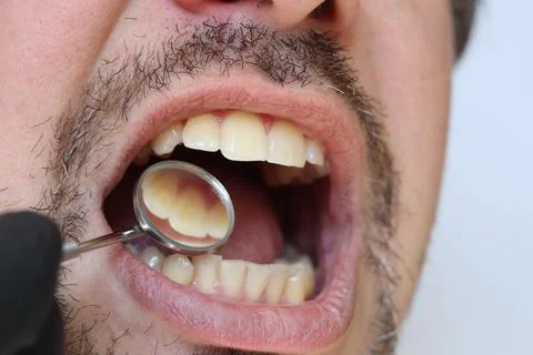 Professional examination of the condition of teeth using a dental mirror Stock Photos
