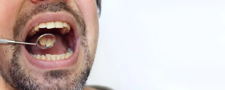 Professional examination of the condition of teeth using a dental mirror Stock Photos