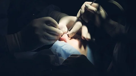 Professional surgeon performing difficult opeartion on a nose in a clinic Stock Footage 124203613