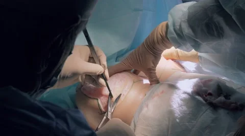 Professional surgeon performing an implants implantation in sterile conditions Stock-Footage 68930444