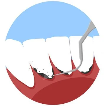 Professional teeth cleaning vector illustration. Book an appointment Stock Illustration