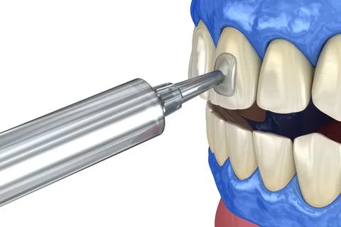 Professional teeth whitening. Adding gel over teeth. 3D illustration concept. Stock Illustration