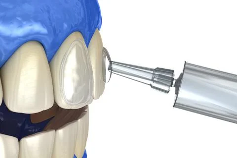 Professional teeth whitening. Adding gel over teeth. 3D illustration concept. Stock Illustration