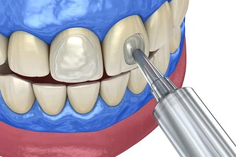 Professional teeth whitening. Adding gel over teeth. 3D illustration concept. Stock Illustration