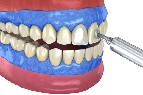 Professional teeth whitening. Adding gel over teeth. 3D illustration concept. Stock Illustration