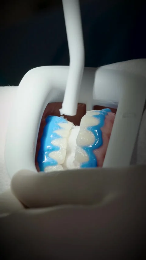Professional teeth whitening procedure with blue gel at dental clinic Stock Footage 343013827