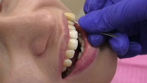Professional teeth whitening procedure. Brushing teeth from a soft plaque Stock Footage 106774167