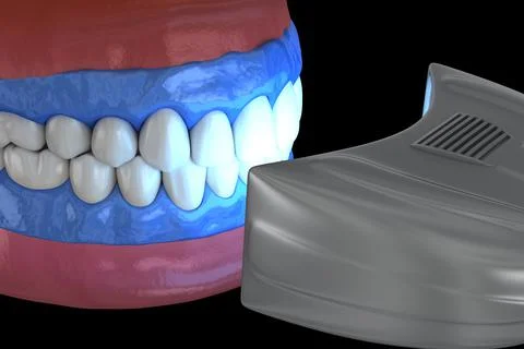 Proffesioinal teeth whitening, light-activation on tooth bleaching. Stock Illustration