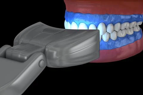 Proffesioinal teeth whitening, light-activation on tooth bleaching. Stock Illustration
