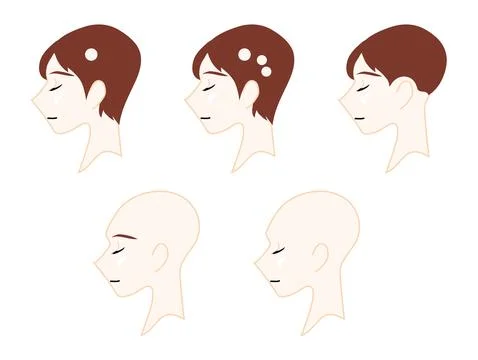 Profile of a neutral person representing the type of alopecia. Stock Illustration