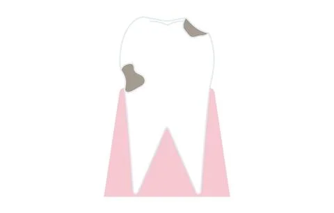 Progress of caries, caries reach dentin Illustrazione stock