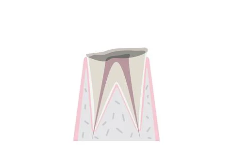 Progress of caries, only the root of the tooth remains with caries Stock Illustration