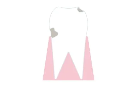 Progress of tooth decay, tooth surface begins to melt Stock Illustration