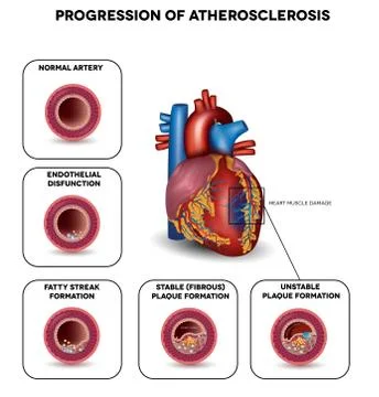 Progression of Atherosclerosis Stock Illustration
