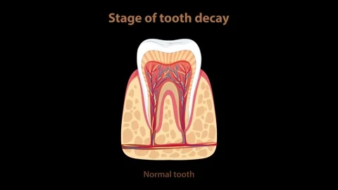 Progression of Tooth Decay Illustrated in Sequential Stages Stock Footage 315014120