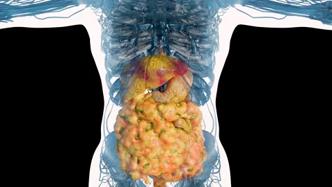 Progressive Accumulation of Visceral Fat and Fatty Liver Disease Video stock 343157142