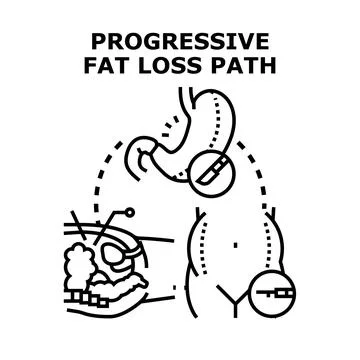 Progressive fat loss path illustrating surgical procedures Stock Illustration