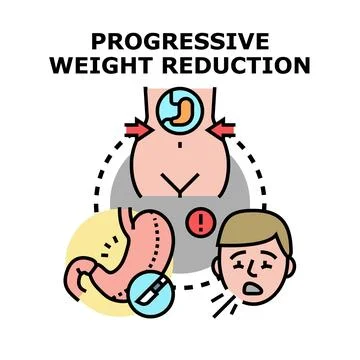 Progressive weight reduction concept with bariatric surgery Stock-Illustration