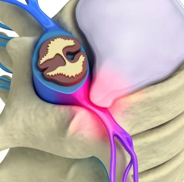Prolapse of intervertebral disc closeup Stock Illustration