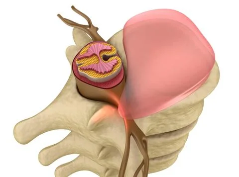 Prolapse of intervertebral disc closeup Stock Illustration