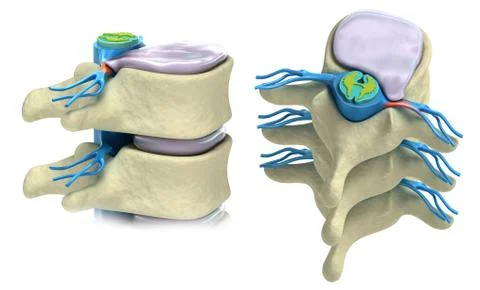 Prolapse of intervertebral disc isolated on white Stock Illustration