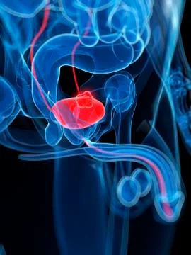 Prostate cancer, artwork Stock Illustration
