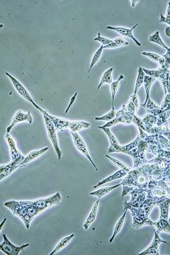 Prostate Cancer cells Microscope view of mens health Prostate Cancer cells... Stock Photos