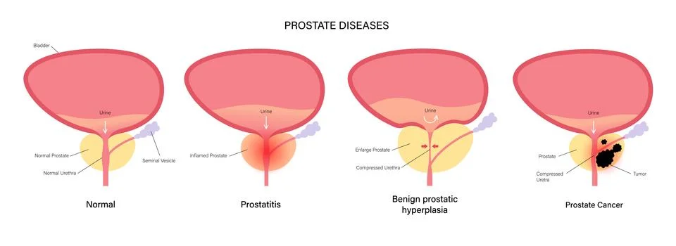 Prostate cancer concept Stock Illustration