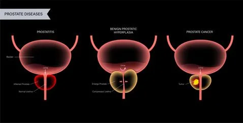 Prostate cancer concept Illustrazione stock