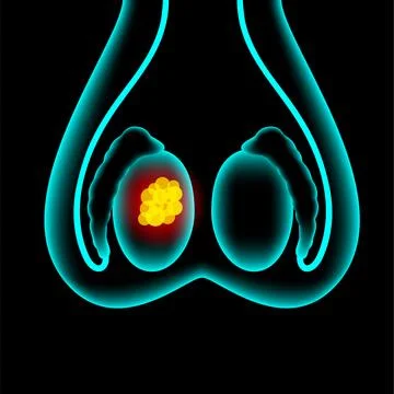 Prostate cancer concept Illustrazione stock