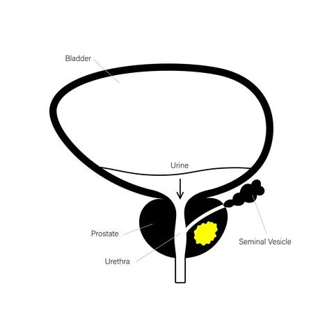 Prostate cancer concept Illustrazione stock