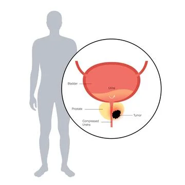 Prostate cancer concept Illustrazione stock