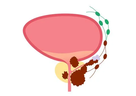 Prostate cancer concept Illustrazione stock