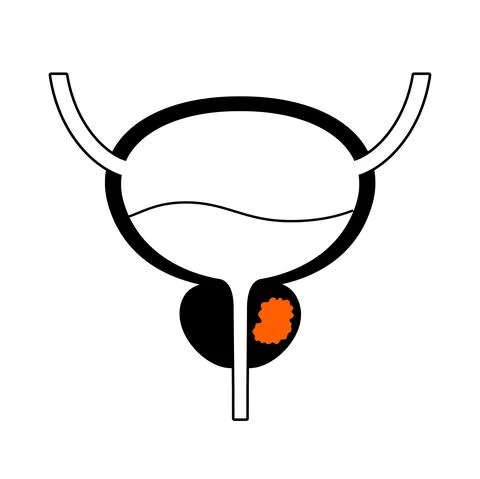 Prostate cancer concept Illustrazione stock