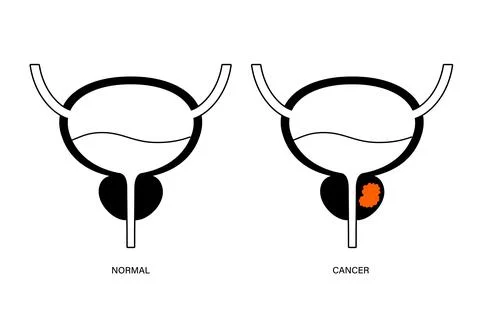 Prostate cancer concept Illustrazione stock