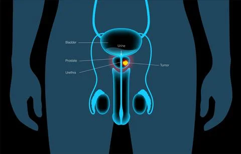 Prostate cancer concept Illustrazione stock