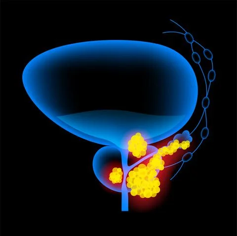 Prostate cancer concept Stock Illustration