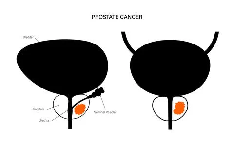Prostate cancer concept Illustrazione stock