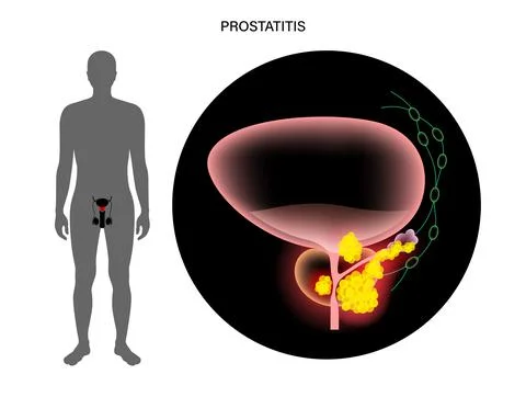 Prostate cancer concept Illustrazione stock