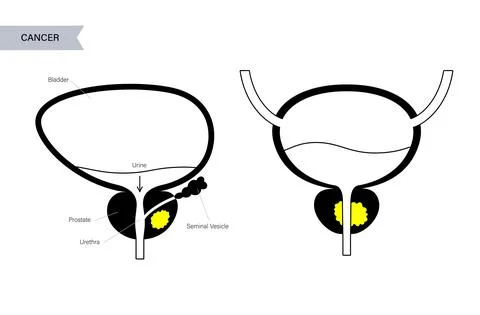 Prostate cancer concept Illustrazione stock