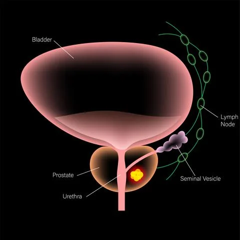 Prostate cancer concept Illustrazione stock