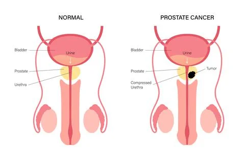 Prostate cancer concept Stock Illustration