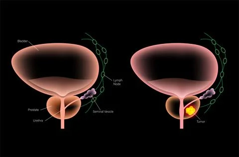 Prostate cancer concept Illustrazione stock