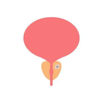 Prostate cancer Stock Illustration