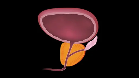Prostate hypertrophy Video stock 27962097