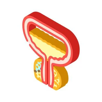 Prostatectomy urology isometric icon vector illustration 库存插图