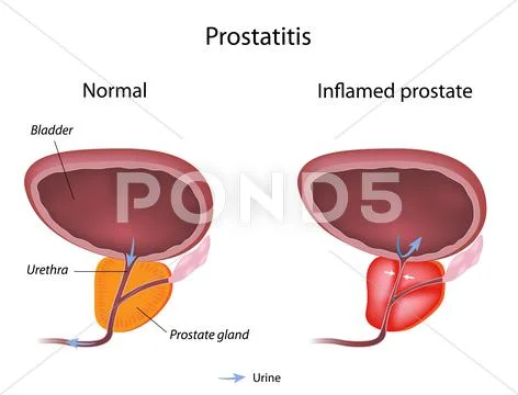 Prostatitis Stock Illustration