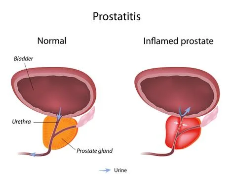 Prostatitis 库存插图