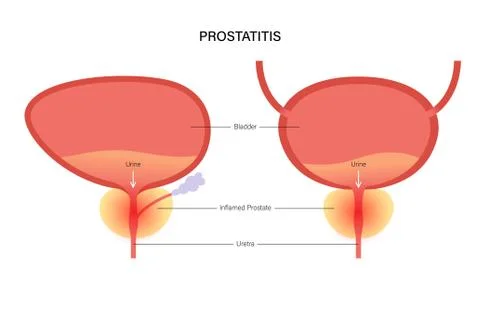 Prostatitis inflammation problem Illustrazione stock