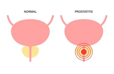 Prostatitis inflammation problem Stock Illustration